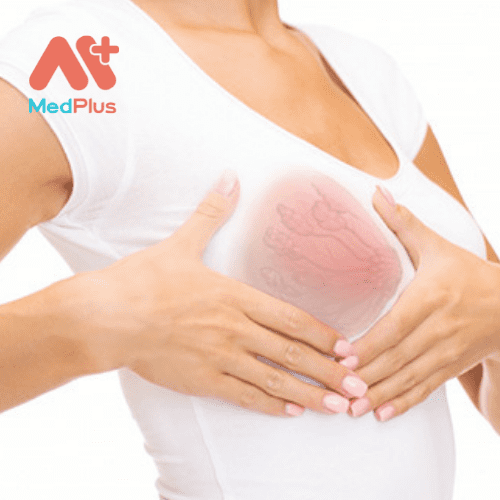 Tổng quan về bệnh Paget ở vú 128 Bệnh Paget là một dạng ung thư hiếm gặp, ảnh hưởng đến núm vú và quầng vú