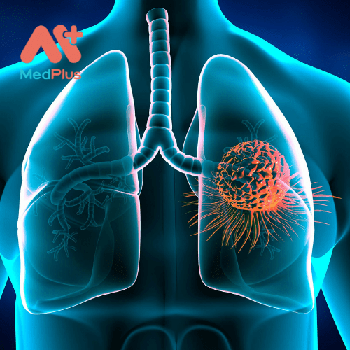 Các giai đoạn ung thư phổi cho bạn biết về mức độ nghiêm trọng của bệnh.
