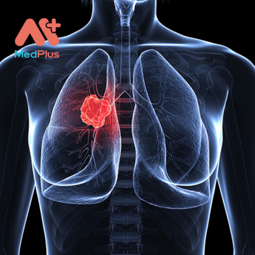 Chẩn đoán ung thư phổi thường được thực hiện thông qua một loạt các xét nghiệm.