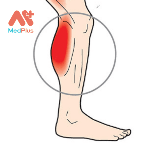 Chấn thương ở một số vị trí có thể gây ra đau bắp chân