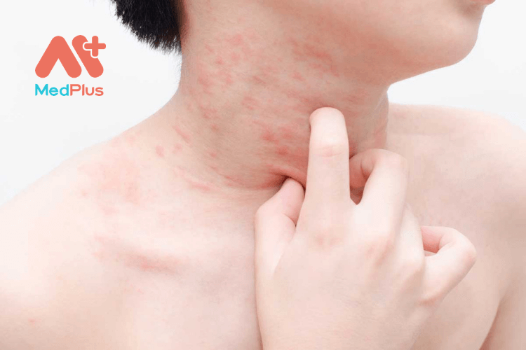 Chế độ ăn cho người bị dị ứng theo mùa