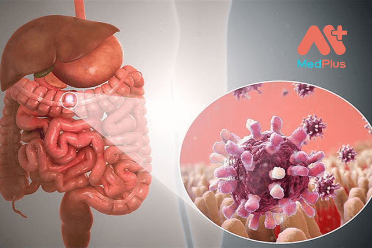 Chế độ ăn cho người bị viêm dạ dày ruột từ chuyên gia y tế