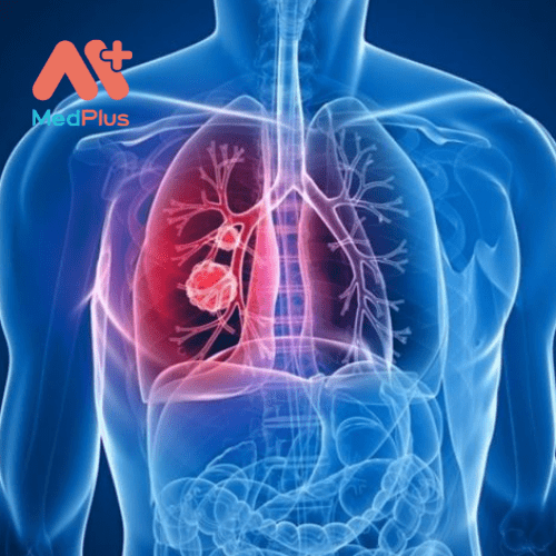 Khi ung thư phổi được chẩn đoán, các bác sĩ sẽ thực hiện các xét nghiệm để xem có di căn hay không.