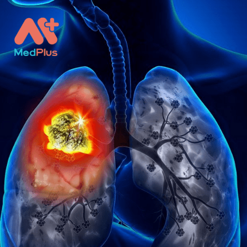 Ung thư phổi di căn đến gan là điều quá phổ biến