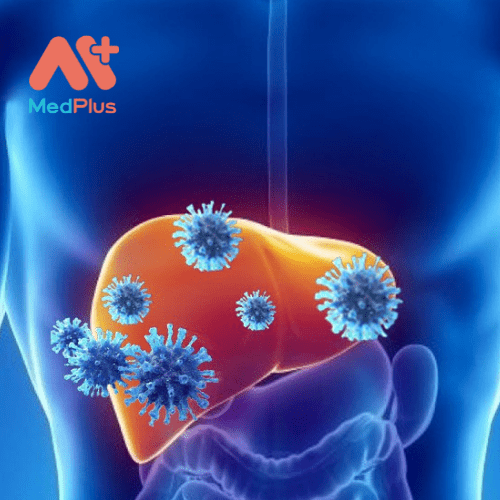 Viêm gan D là một bệnh nhiễm vi rút nghiêm trọng gây viêm gan.  