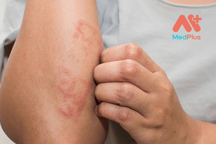 chế độ ăn cho người bị bệnh chàm