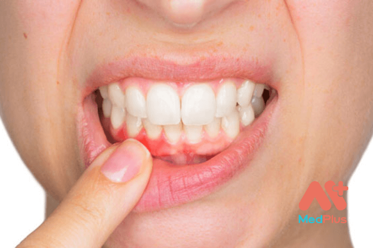 7 nguyên nhân khiến nướu răng bị đỏ