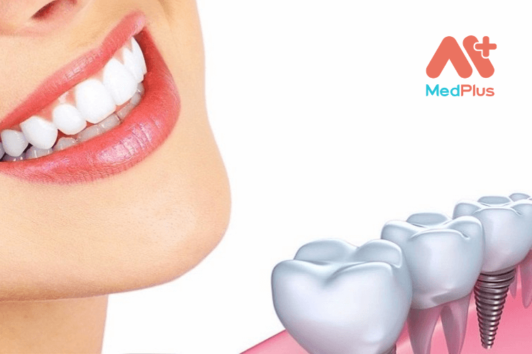 Răng implant có bị đào thải hay không?