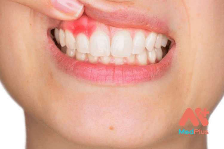 Tất tần tật về áp xe nha chu - Bệnh lý răng miệng nguy hiểm