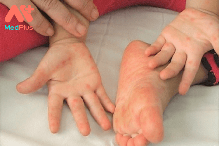 Bệnh tay chân miệng ở trẻ em phải làm sao?