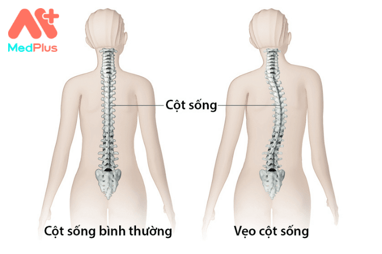 Trẻ bị gù vẹo cột sống học đường