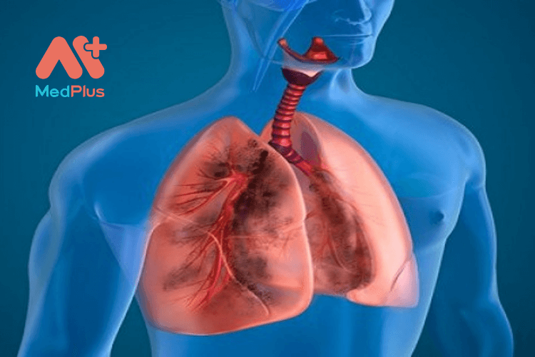 Xơ phổi vô căn là bệnh gì?