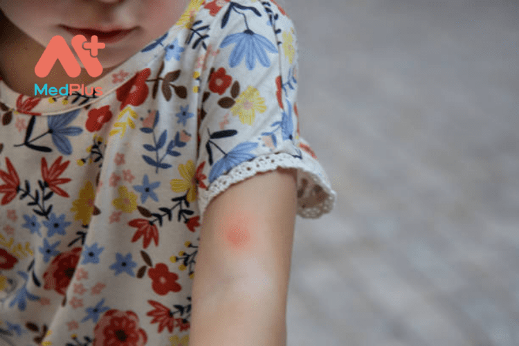 Cách điều trị và ngăn ngừa muỗi đốt ở trẻ em