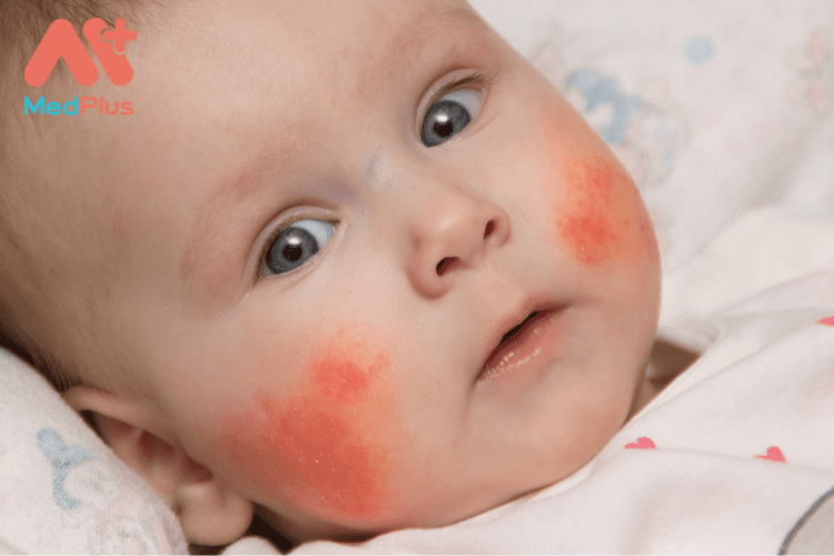 Điều trị dị ứng theo mùa ở trẻ em