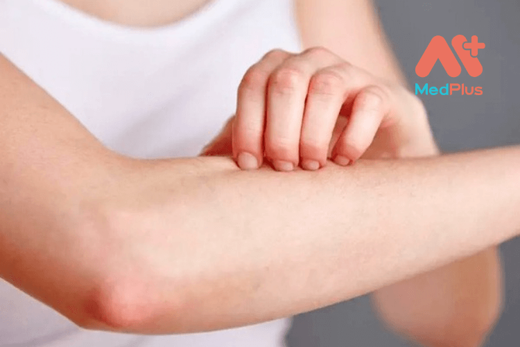 Rôm sảy ở người lớn: Giải đáp 5 câu hỏi thường gặp về tình trạng này