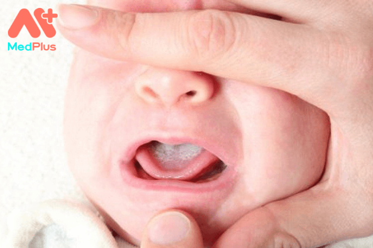 Trẻ sơ sinh bị tưa lưỡi có sao không?