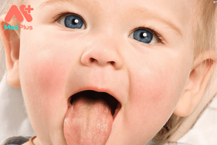 Trẻ sơ sinh bị tưa lưỡi có sao không?