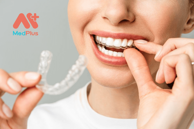 Máng tẩy trắng răng có thật sự hiệu quả?