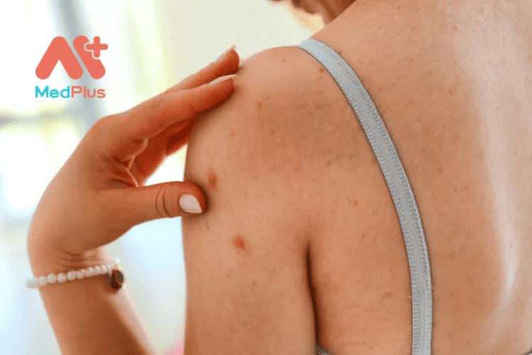 Mụn cơ thể: Cách làm sạch mụn trên cơ thể 135 Mụn cơ thể: Cách làm sạch mụn trên cơ thể