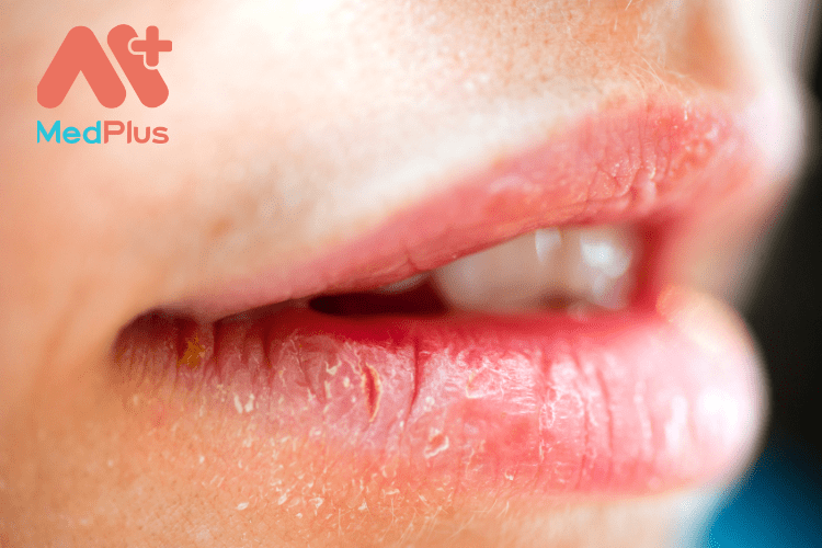 6 mẹo bảo vệ môi của bạn khỏi thời tiết khô hanh