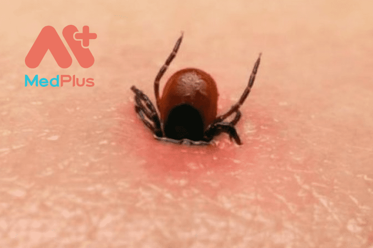 Top 11 Bài Viết Về Bệnh Lyme Cực Chi Tiết 129 Bệnh Lyme phổ biến nhất ở khu vực châu Á
