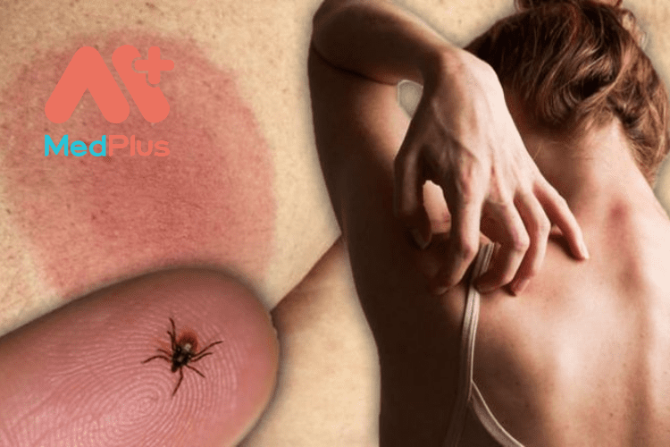 Top 11 Bài Viết Về Bệnh Lyme Cực Chi Tiết 130 Cần cảnh giác cao với bệnh Lyme