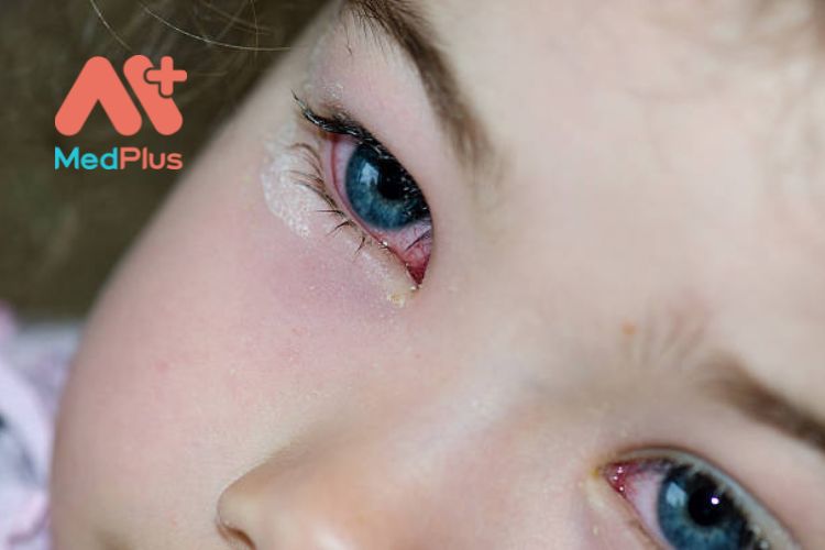 Đau mắt đỏ ở trẻ em
