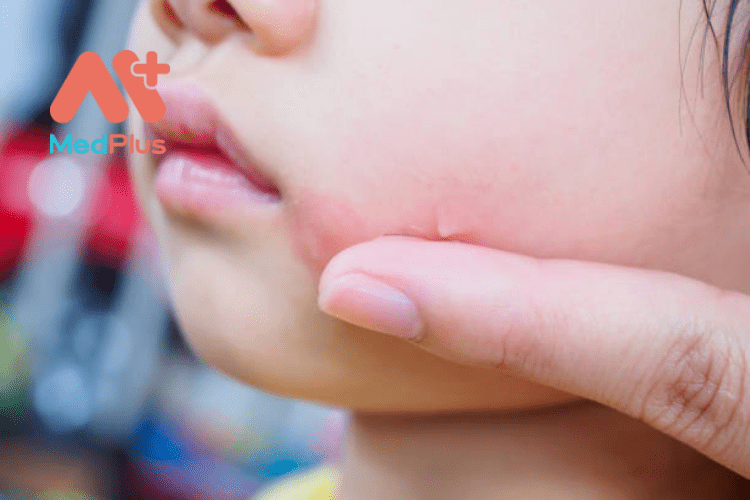 Trẻ bị nổi mẩn đỏ trên mặt