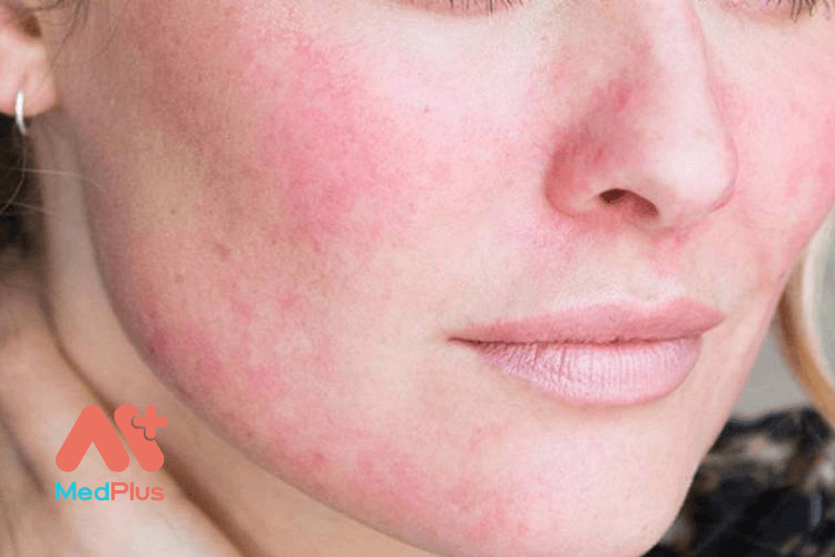 da nhay cam 1 - Medplus