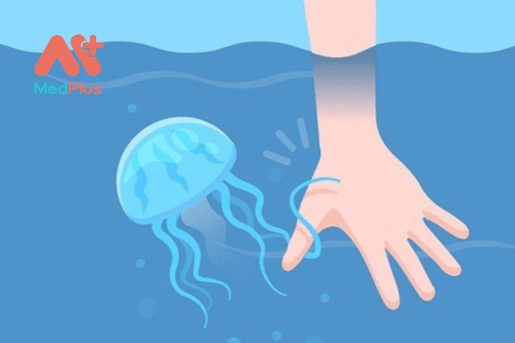Nên làm gì khi sứa biển cắn?