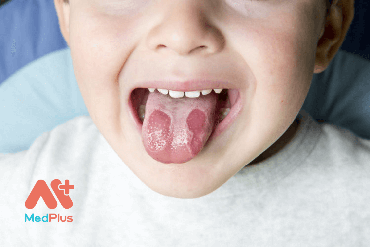 Viêm lưỡi bản đồ ở trẻ: Nguyên nhân, triệu chứng và cách điều trị hiệu quả
