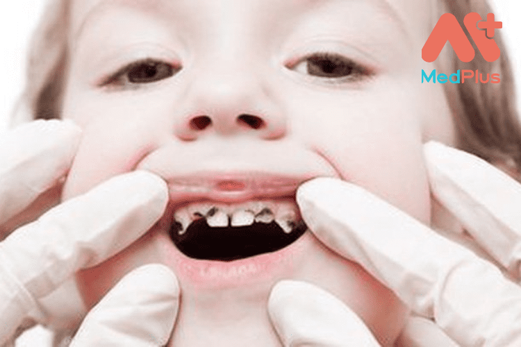 Tổng hợp 10 bài viết về Sâu răng hay nhất 2022