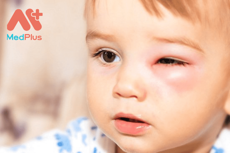 Tổng hợp 15 bài viết về bệnh đau mắt đỏ chi tiết nhất 2022