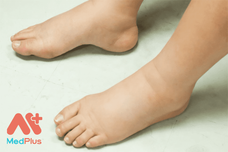 Top 12 bài viết về bệnh Phù chân hay nhất 2022