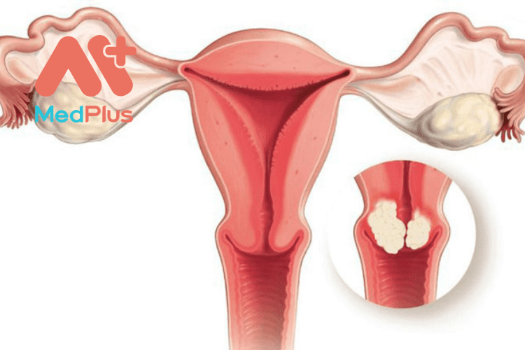 U xơ tử cung là bệnh lý nguy hiểm ở phụ nữ
