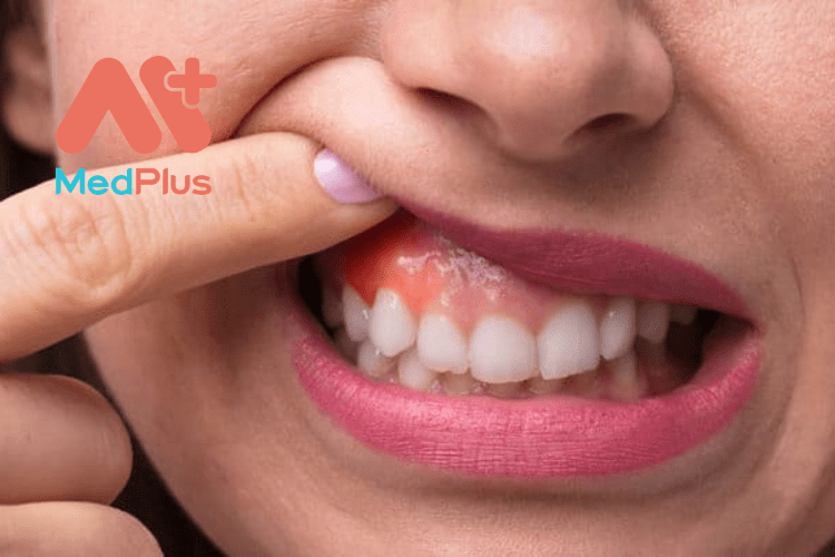 Viêm nướu răng là tình trặng bệnh răng miệng phổ biến