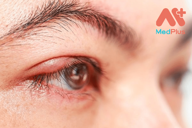 Bệnh lẹo mắt và top 10 bài viết hữu ích 2022