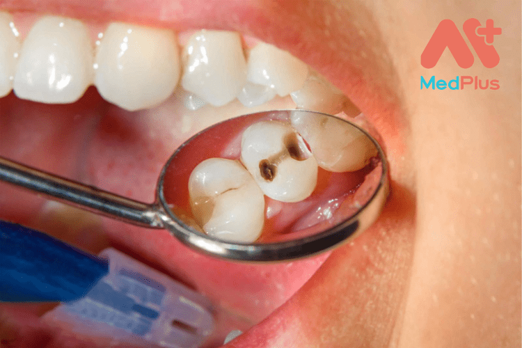 Danh sách 10 bài viết về Viêm tủy răng mới nhất 2022
