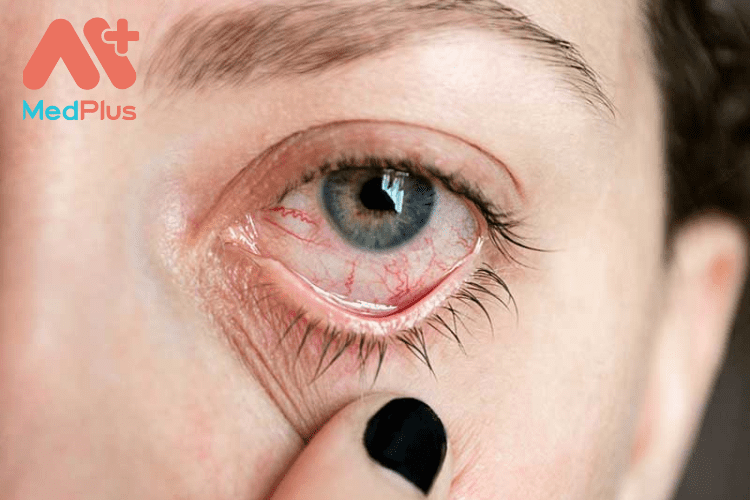 Viem mang bo dao va 10 bai viet moi nhat 2022 - Medplus