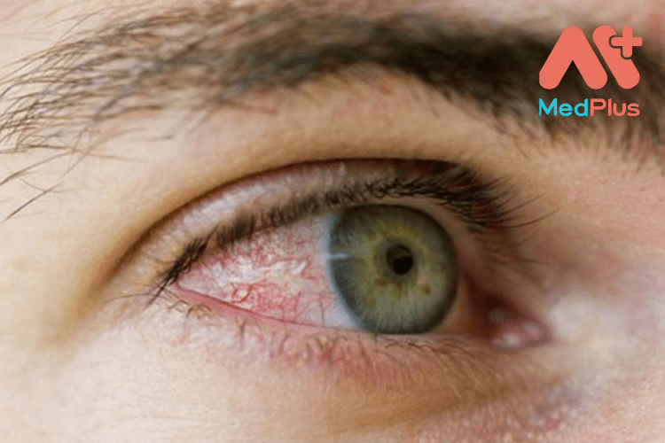 Viêm màng bồ đào và Top 10 bài viết mới nhất 2022