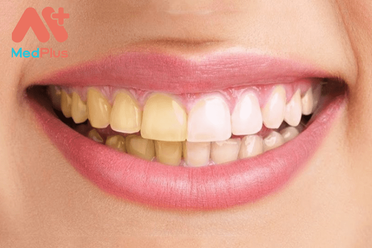 Voi rang va 10 bai viet moi nhat 2022 - Medplus