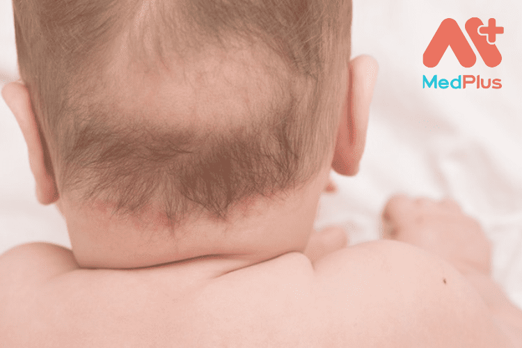 [TOP 10] bài viết về Rụng tóc vành khăn ở trẻ sơ sinh mà các mẹ nên tham khảo 2022