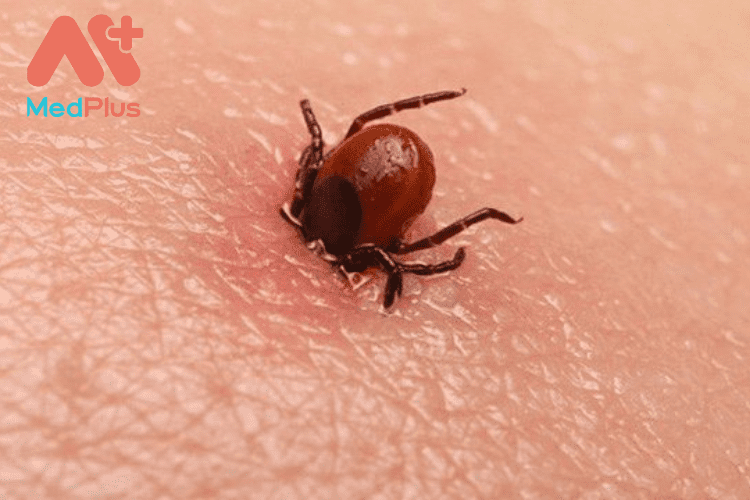 [TOP 10] bài viết về Bệnh Lyme chi tiết 2022