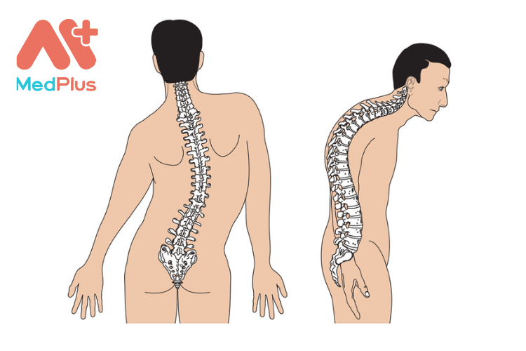 Vẹo cột sống ở người lớn TOP 10 bài viết đáng xem 2022
