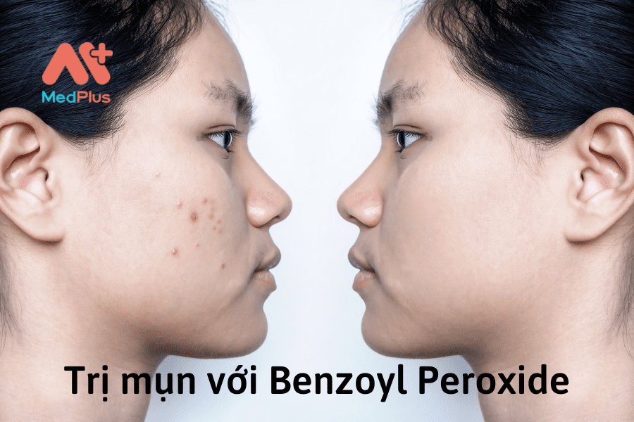 trị mụn với benzoyl peroxide