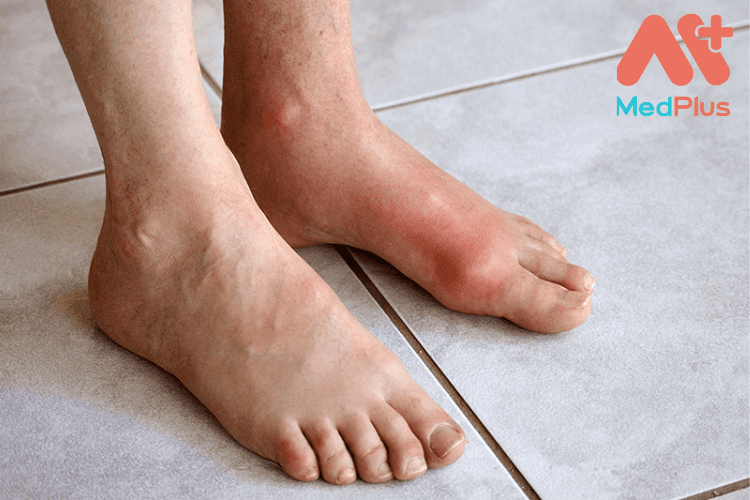 bệnh gout