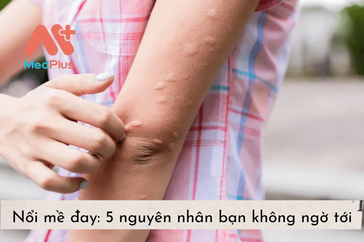 Nổi mề đay: 5 nguyên nhân bạn không ngờ tới