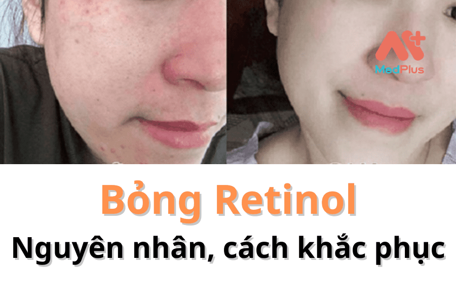 BỎNG RETINOL LÀ GÌ? NGUYÊN NHÂN VÀ CÁCH KHẮC PHỤC