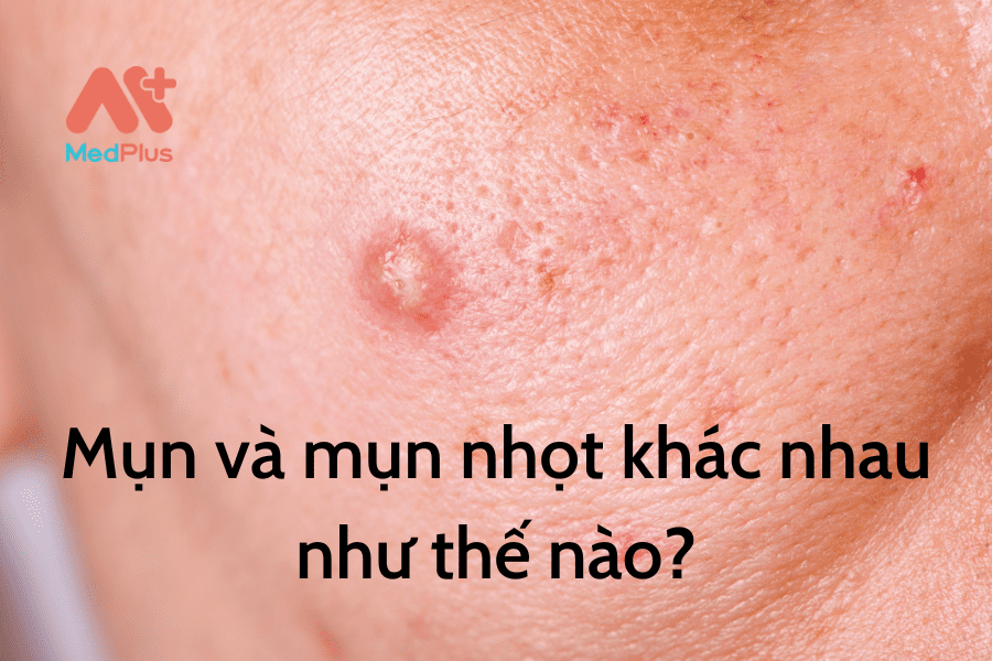 Mụn và mụn nhọt khác nhau như thế nào