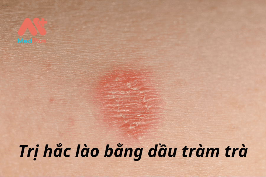 Bệnh hắc lào